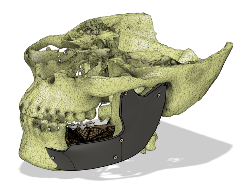 3D CAD model of a skull with a custom mandibular prosthesis fitted